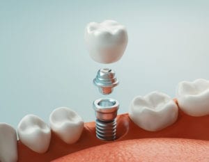 Affordable Dental Implants in media, pa