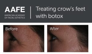 botox dentist in media pa for crows feet