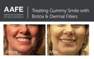 botox dentist in media pa for gummy smile