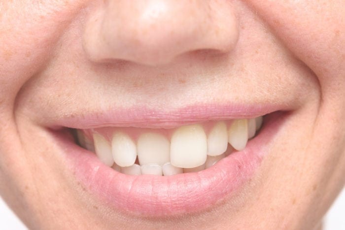 Straighten Crooked Teeth in Media, PA