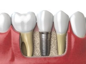 affordable dental implants in media, pennsylvania