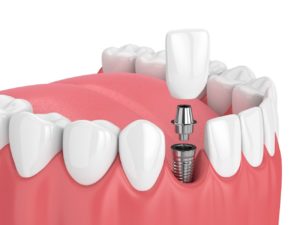 types of dental implants Media Pennsylvania