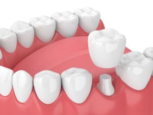 dental crown procedure in Media Pennsylvania
