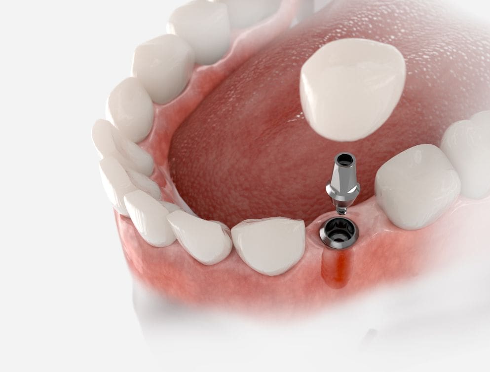 Components of Your Dental Implant Dentists in Media, PA