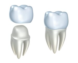 What Can a Dental Crown Do