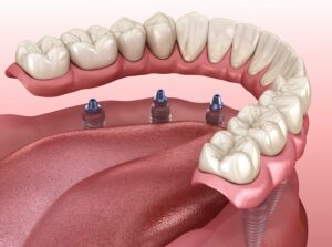 Know Your Options for Dentures