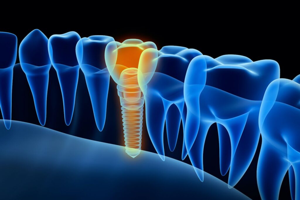 Dental Implant Recovery FAQs