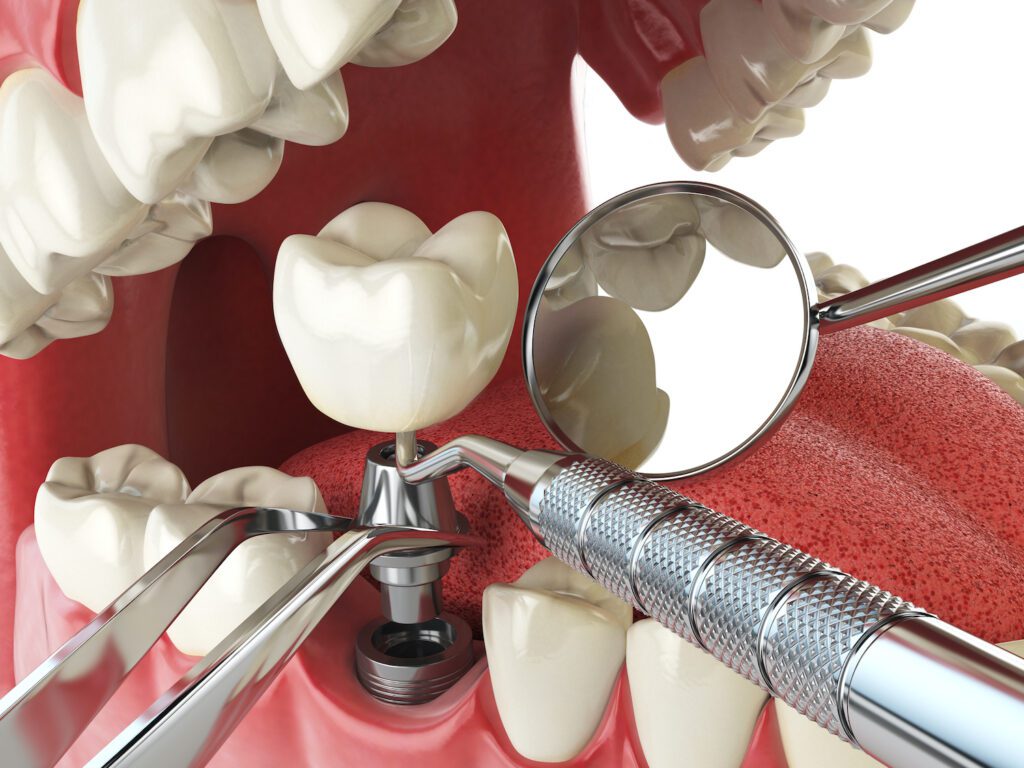 Many people find dental implants improve their quality of life, but they may not be available for everyone.