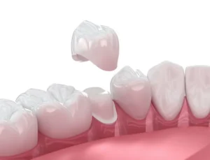 Can a Chipped Tooth Be Saved? in Media, PA
