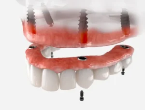 Implant-Supported Dentures Could Change Everything in Media, PA